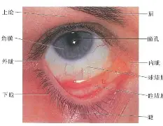 疤痕眼睑退缩图片大全